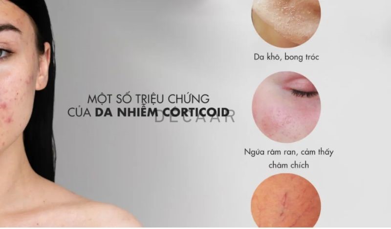 thời gian đào thải corticoid